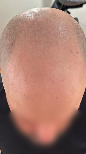He hasn’t grown hair in years. 

You’d never know from here. 

Scalp micropigmentation, Bucks County
