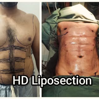 Liposuction Get rid of fat with liposuction in Rawalpindi and Islamabad fat reduction treatment for 