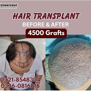 Hair Transplant FUE
4500 grafts in mega session 

COSMESURGE AESTHETICS