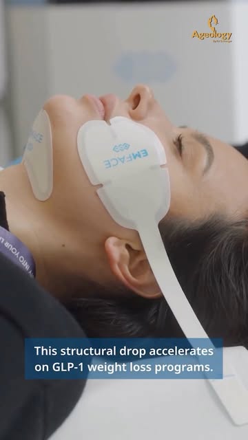 Rapid weight loss can cause facial muscles to lose firmness and lead to fat descent, often called "O