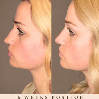 6 weeks after Revision Rhinoplasty ✨

Even in the early stages of healing, her results are already t