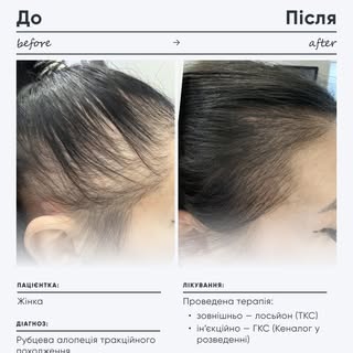 #Результати_HairMed
Пацієнт: жінка
 Діагноз: рубцева алопеція тракційного походження.
Проведена тера