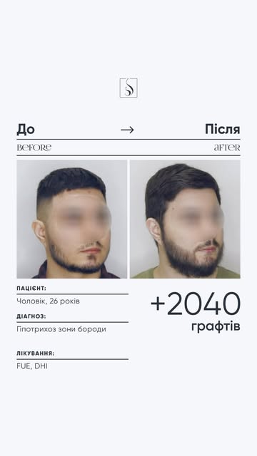 #Результати_HairMed

Пацієнт: чоловік, 26 років Діагноз: гіпотрихоз зони бороди

Об’єм: 2040 графтів