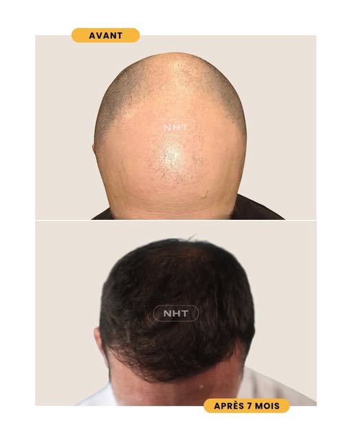 Une transformation totale de la chevelure, de la ligne frontale jusqu’au vertex !

✨ Résultat à 7 mo