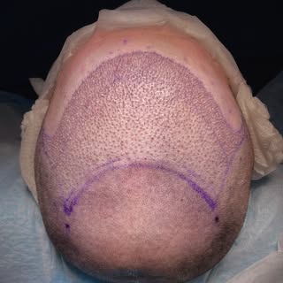 Immediate post-op results following a 2030-graft FUE procedure. The patient was seeking to restore h