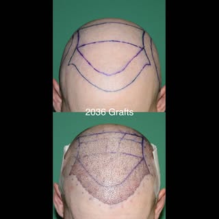Immediate post-op photos after a 2036-graft FUE procedure.

The patient's goal was a natural-looking