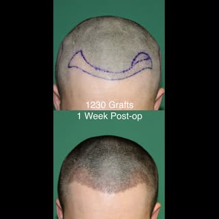 Immediate and 1-week post-op photos after a 1230-graft FUE procedure.

Fine hairs were harvested to 