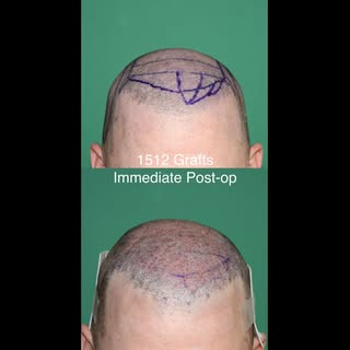 Immediate post-op photos after a 1512-graft FUE procedure.

This patient previously had hair transpl