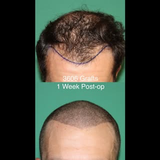 1 week post-op results after 3606-graft FUE surgery.

Grafts were placed one at a time by hand over 