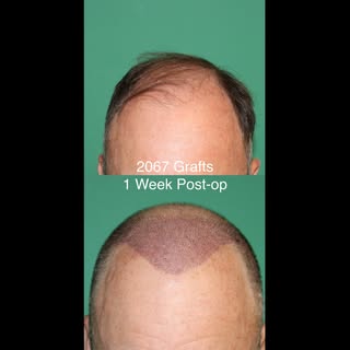 1 week post-op results after 2067-graft FUE surgery.

This patient requested a conservative hairline