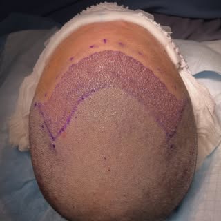 Immediate post-op results following a 2009-graft FUE procedure.

#fue #hairtransplant #hairloss #hai
