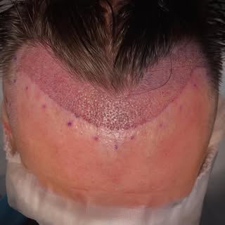 Immediate post-op results after a 1210-graft FUE procedure.

#fue #hairtransplant #hairloss #hairlin