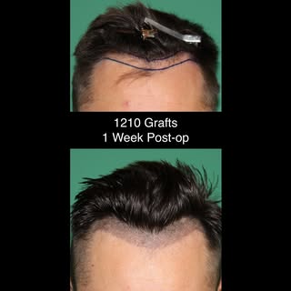 1 week post-op results after a 1210-graft FUE procedure.

#fue #hairtransplant #hairloss #hairline #