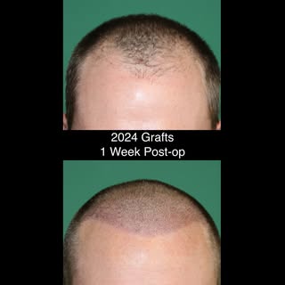 1 week post-op results after a 2024-graft FUE procedure.

#fue #hairtransplant #hairloss #hairline #