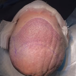 Immediate post-op results following a 2010-graft FUE procedure.

#fue #hairtransplant #hairloss #hai
