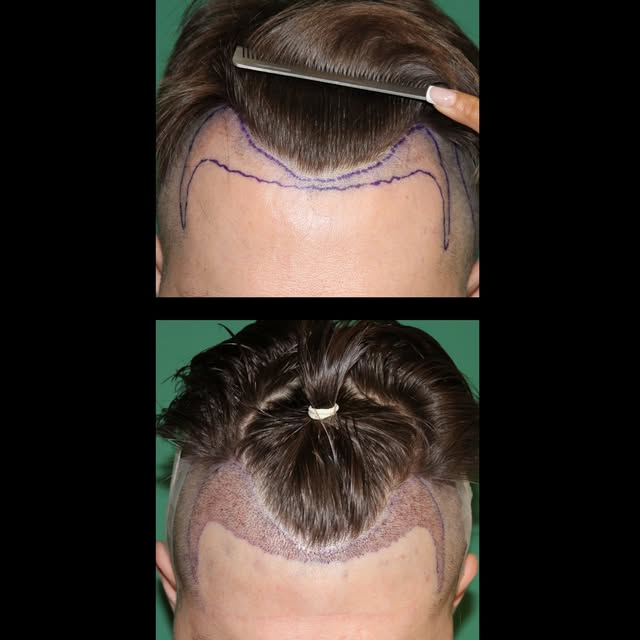 Immediate post-op results following a 1419-graft FUE procedure.

#fue #hairtransplant #hairloss #hai