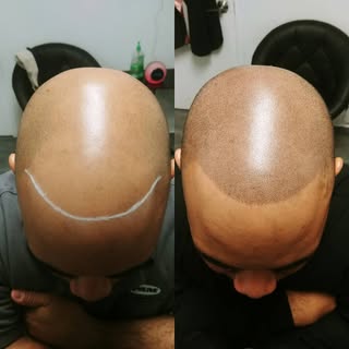And done!
#scalpmicropigmentation #smp #bald #baldfade #barber #barbershop #hairloss #hair #permanen