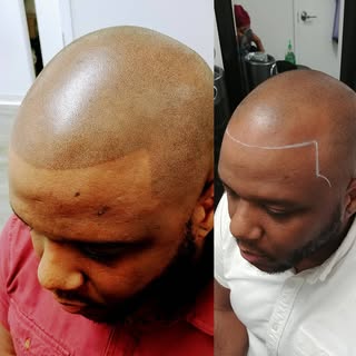 Yeah buddy! 2 sessions totaling 6 hours!
#scalpmicropigmentation #smp #bald #baldfade #barber #makeo