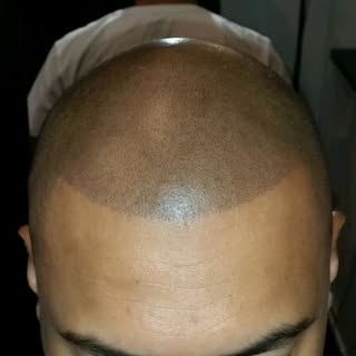 This client doesn't actually have any hair on the top of his head! 
When people see it in person the