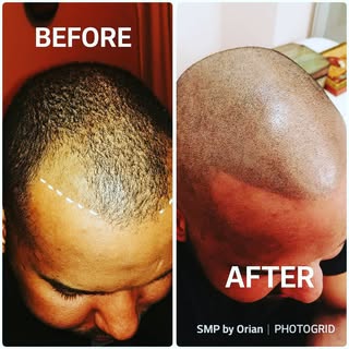 Choosing the right hairline was important because as you can see, he still has hair and you always w