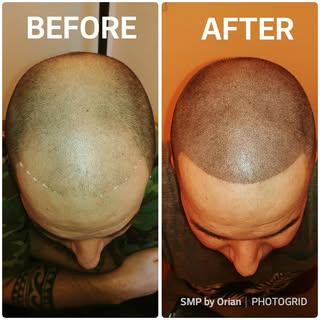 I'm one of the first handful of SMP artists to practice in the United States! 
#headtattoo #hairtatt