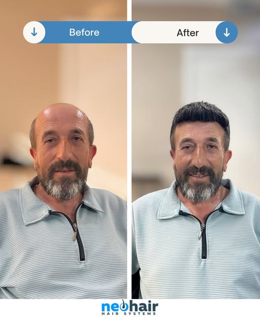 Yılları geride bırakan, %100 doğal bir dönüşüm. ✂️✨ Seyrelme ve dökülme sorununa en konforlu ve este