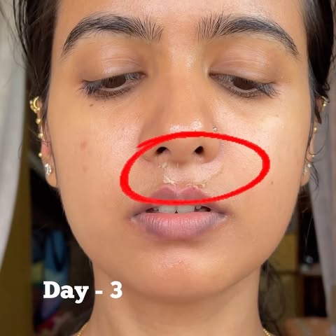 Double Peeling ! 🤌🏻♥️

USP’s:
- Reduce finelines
- Treats sundamages & certain type of acnes
- Rem