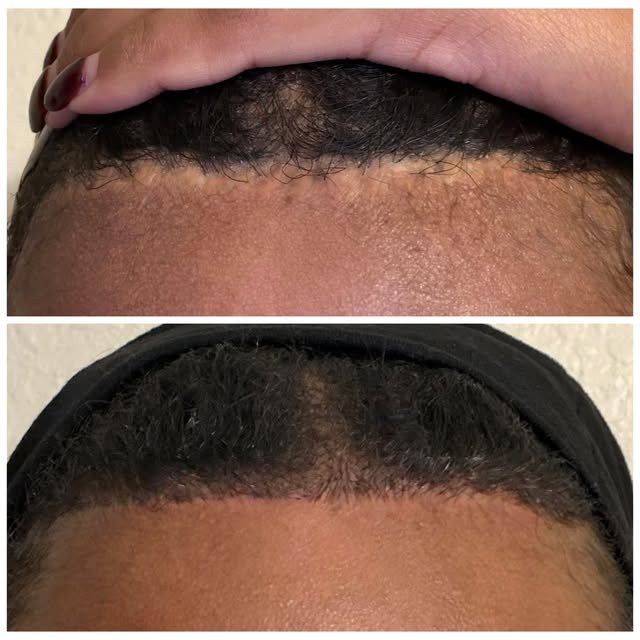 Hairline scar camouflage. #minnetonka #stlouispark #edinaplasticsurgery #edina#plasticsurgery