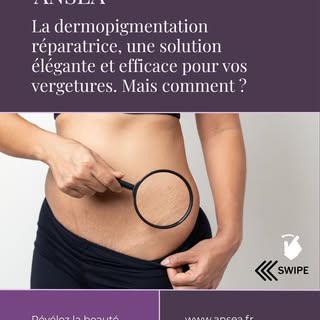 Vous n'en pouvez plus de vos vergetures blanches ? Voici la solution !
Consultation préalable gratui