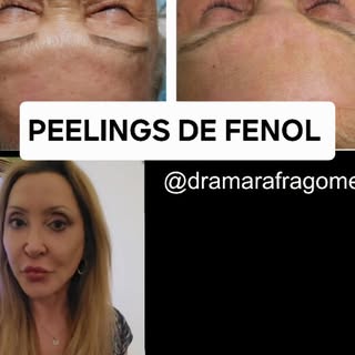 Agora, é possível conquistar resultados incríveis sem a agressividade de antes. Os novos peelings de