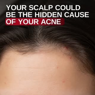 Have you heard of hairline acne?

Breakouts along the forehead, temples, and hairline aren’t always 