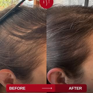 Struggling with hair issues? 

With 20 years of expertise and UK Board Certified Clinical Trichologi