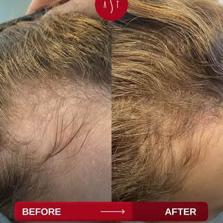 Struggling with hair issues? 

With 20 years of expertise and UK Board Certified Clinical Trichologi