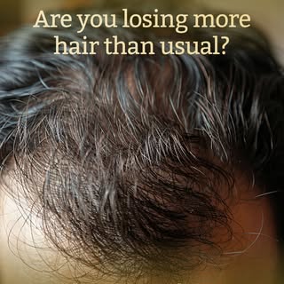 Losing more hair than usual? Here are 3 signs it could be telogen effluvium, and not just everyday s