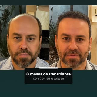 Com 8 meses de transplante, este resultado já alcança entre 60% e 70% da evolução esperada.

A tendê