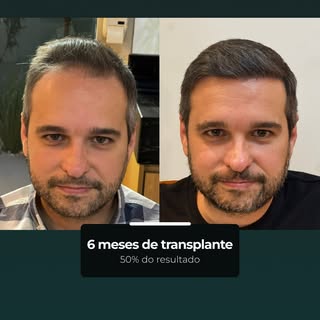 Com 6 meses, o transplante já revela uma mudança bem visível no contorno e na presença dos fios. É u