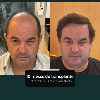 Com 10 meses, o transplante já entra em uma fase em que o resultado fica mais próximo do desenho pla