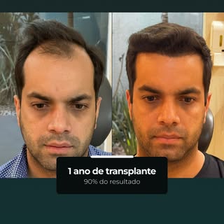 Com 1 ano, o transplante já mostra cerca de 90% do resultado esperado, com aspecto mais maduro e nat
