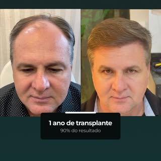 Com 1 ano, o transplante já mostra cerca de 90% do resultado esperado, com um visual mais definido e