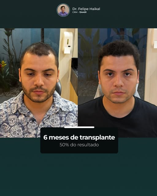 Com 6 meses de transplante capilar, esse paciente já apresenta uma evolução muito positiva.

É nessa