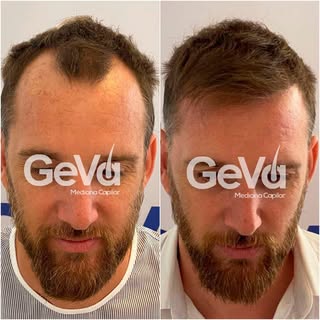 🟢Antes y después Microimplante Capilar Técnica FUE.

🟢Paciente con evolución de 9 meses.👨‍🦲🧓

�