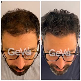 🟢Antes y después Microimplante Capilar Técnica FUE. @gevacapilar 

🟢Paciente con evolución de 12 m