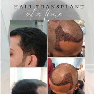 We often come across men who lose confidence when they start balding. We understand the impact hair 