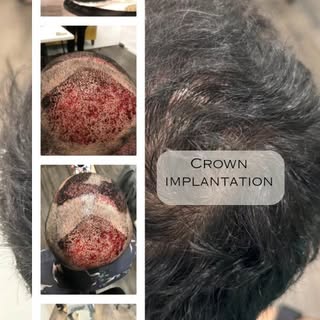 Know all about hair transplants from our expert hair restoration surgeons.

Typically, front / hairl