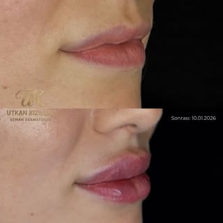 Dudak Dolgusu 👄

Dudak dolgusu uygulamalarında amaç yalnızca hacim vermek değil; yüz oranlarıyla uy