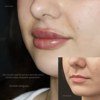 Dudak Dolgusu 👄

Dudak dolgusu uygulamalarında amaç yalnızca hacim vermek değil; yüz oranlarıyla uy