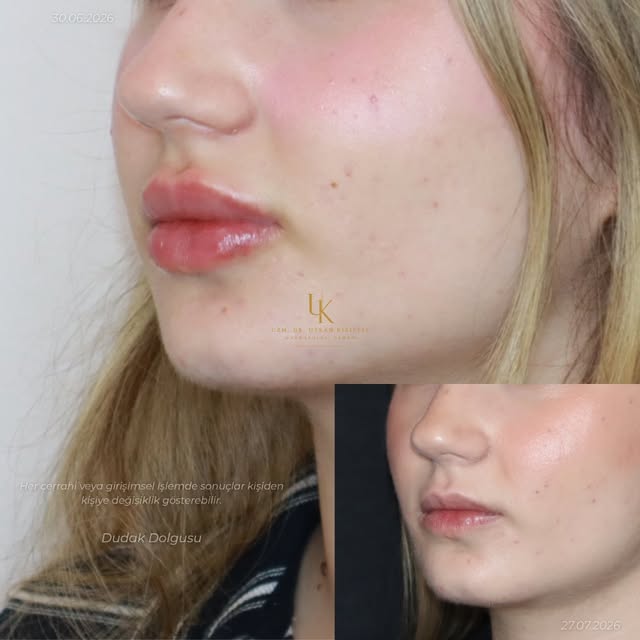 Dudak dolgusu 💋
Daha belirgin kontur, daha dengeli bir görünüm.

Her cerrahi veya girişimsel işlemd