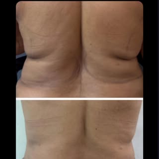 Bra rolls. That stubborn ridge of fat that sits right along your bra line — no matter how much you d