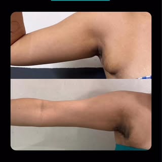 Axillary breast tissue Surgery.

#sehore #bina #ashoknagar #ashta