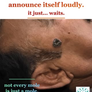 #dermatologicalmalignancy #skincancer #skinlesion #moleremowal #sehoreplasticsurgery